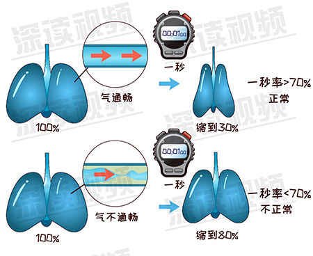 最新治療慢阻肺辦法,最新治療慢阻肺辦法，突破與創(chuàng)新